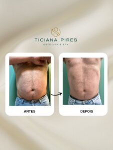 Antes e Depois Tratamento Ônix