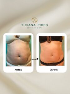antes e depois tratamento Ônix + Power Shape