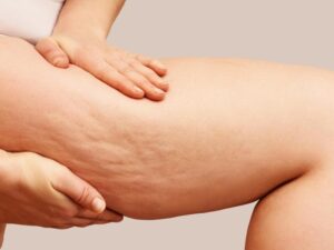 Tratamento para celulite corporal na Clínica Ticiana Pires Estética e SPA